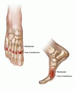 metatarsal pad for runners