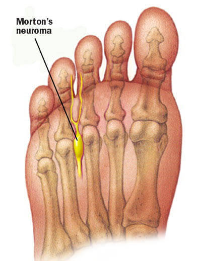 Sharp stabbing pain hot sale in bottom of foot