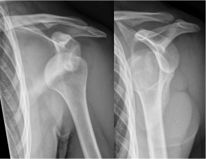 Dislocated shoulder X-ray courtesy of Hellerhoff (Own work) [CC-BY-SA-3.0 (http://creativecommons.org/licenses/by-sa/3.0)], via Wikimedia Commons