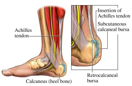 calcaneal tendonitis treatment