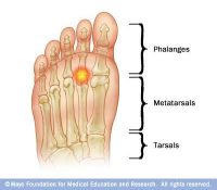 Plantar Plate Sprain/Tear Specialist San Diego | San Diego Injury Clinic