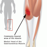 Tennis Leg, Medial Gastrocnemius Syndrome or Torn Medial Gastrocnemius