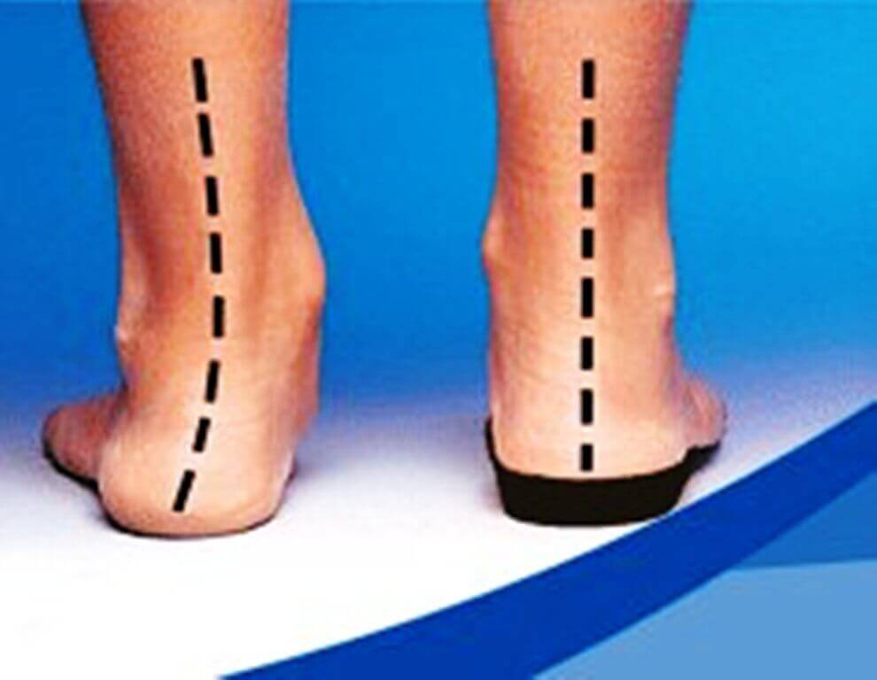 custom molded foot orthotics