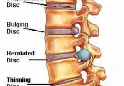 Disc Bulges, Protrusions, Herniations and Extrusions - San Diego ...