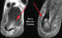 Bone Marrow Edema - San Diego Running & Sports Injury Clinic