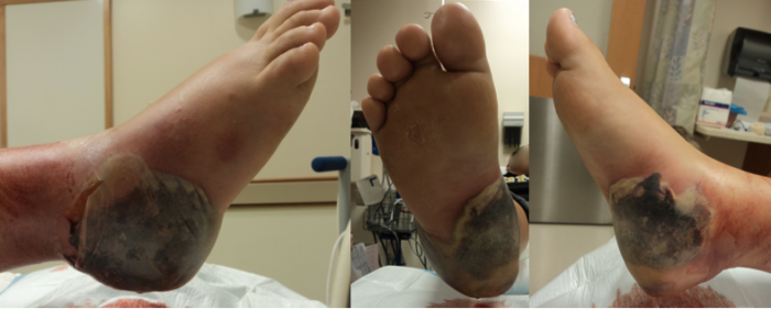 foot spur removal